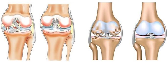 Kini arthritis ati arthrosis